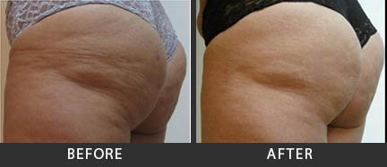 skin chemical peel treatment Photos After Cellulite Before and Treatment