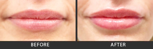 Juvederm Before and After Photos