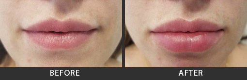 Juvederm Before and After Photos